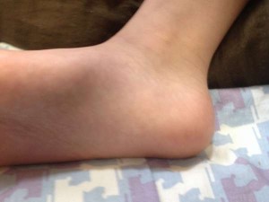 小学生の踵の痛みはシーバー病？原因と症状｜対処法は？